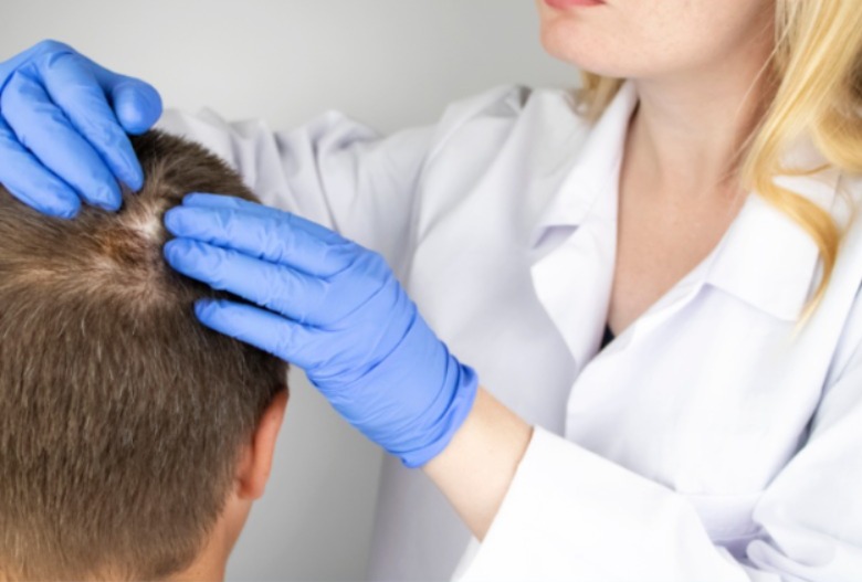 ALOPECIA