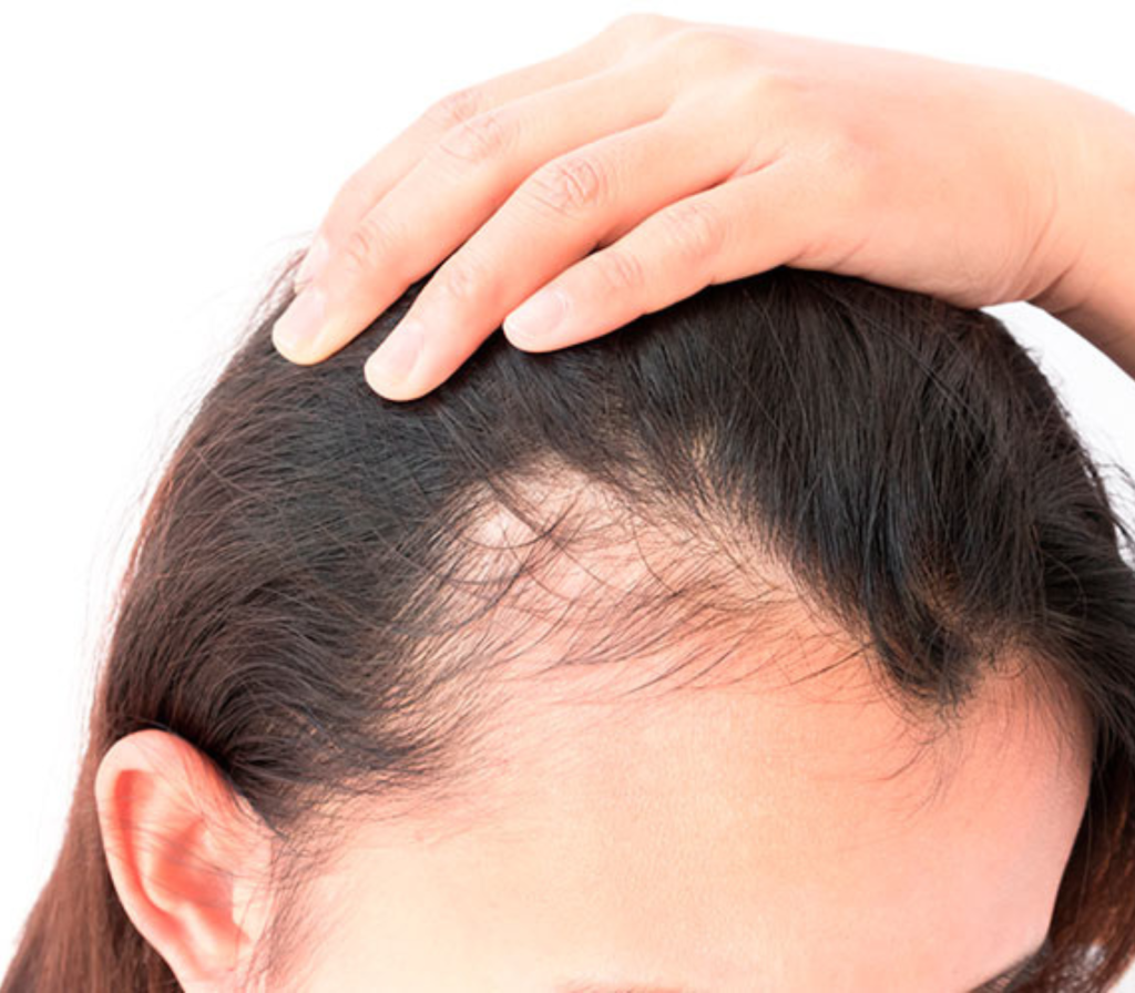 ALOPECIA
