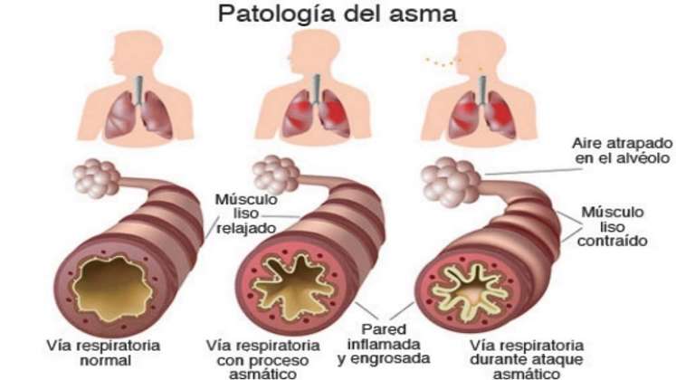 Así se ve la enfermedad. / Foto: Cortesía / La Opinión 