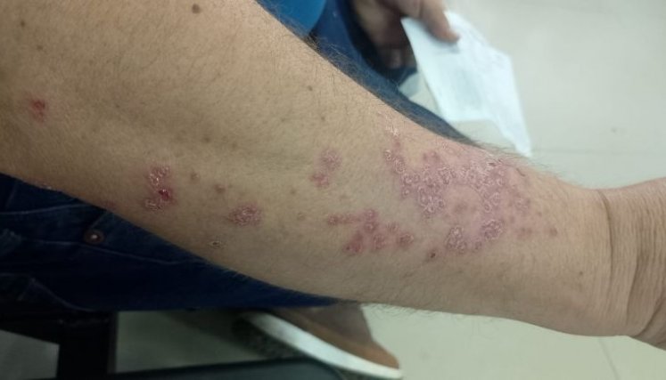 psoriasis-paciente