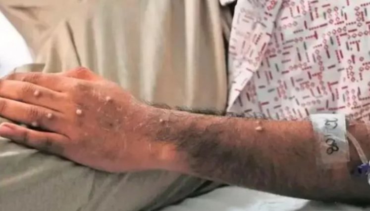 En Antioquia fue confirmado el primer caso de viruela símica del tipo más grave/Foto Colprensa