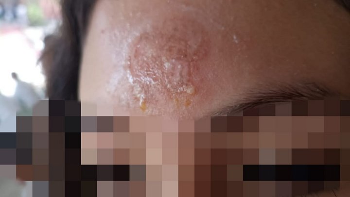 Quemados en Chinácota