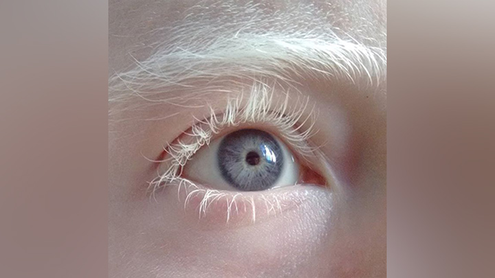 Según expertos médicos, los albinos pueden padecer también de albinismo ocular.