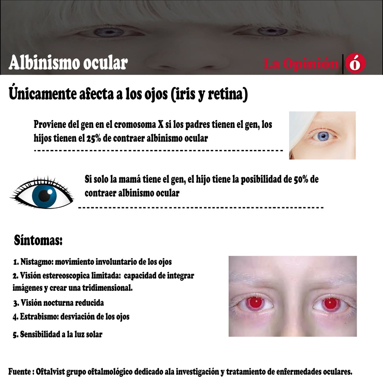 El albinismo ocular no afecta generalmente el color de pelo o piel de quien lo padece.