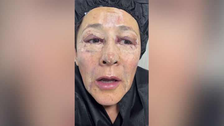 La actriz fue movilizada en silla de ruedas luego de salir del consultorio en el que fue intervenida.