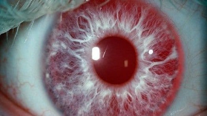 La fotofobia es uno de los síntomas de esta enfermedad.