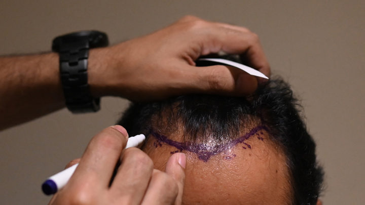Trasplante capilar./AFP. 