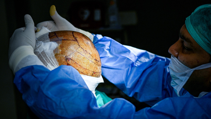 Trasplante capilar./AFP. 