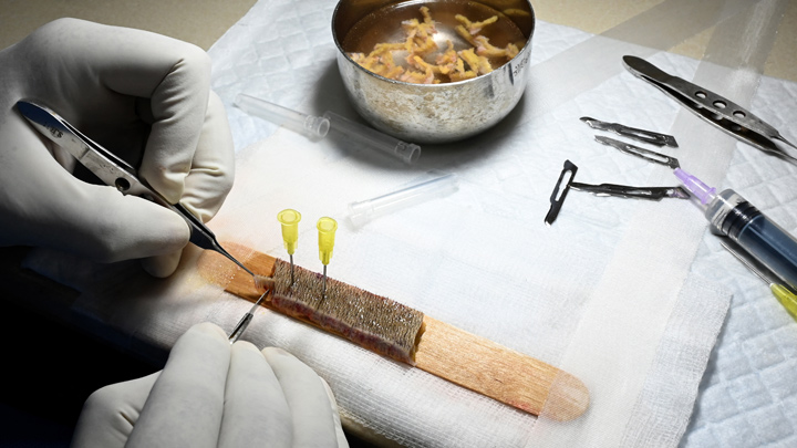 Trasplante capilar./AFP. 