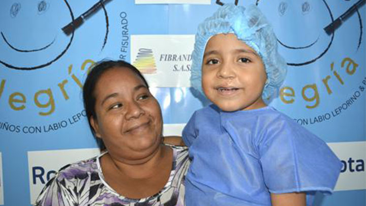 paladar y labio hendido