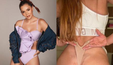 La actriz habló de la marca que le dejó la extracción de biopolímeros