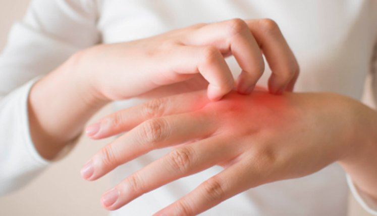 La dermatitis no es contagiosa, pero puede hacer que te sientas incómodo y cohibido. / Foto: Cortesía