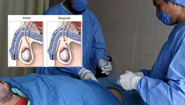 Vasectomía
