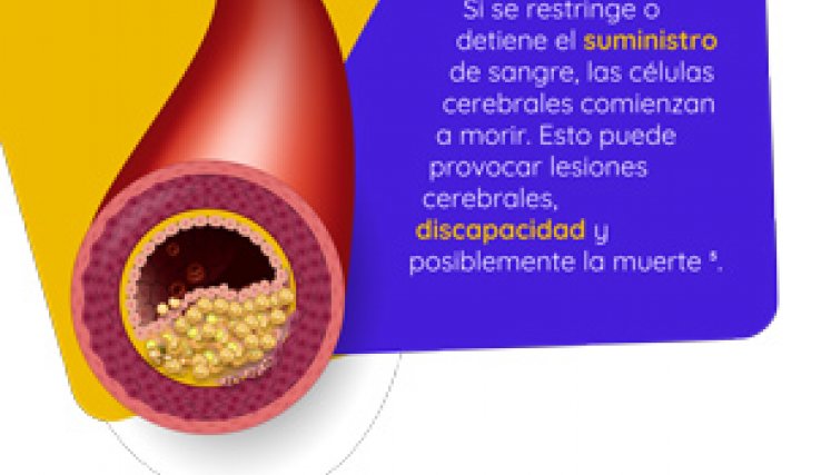 ACV