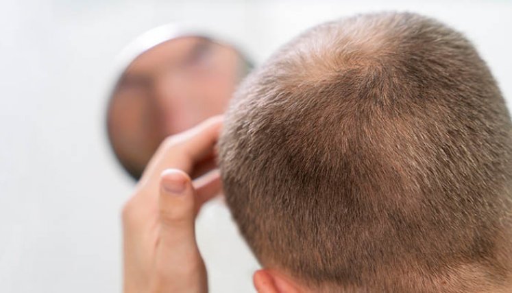 Aprueban píldoras para la caída del cabello. 