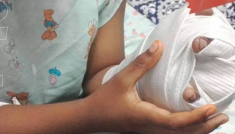 Aumentó el número de quemados  con pólvora en Norte de Santander