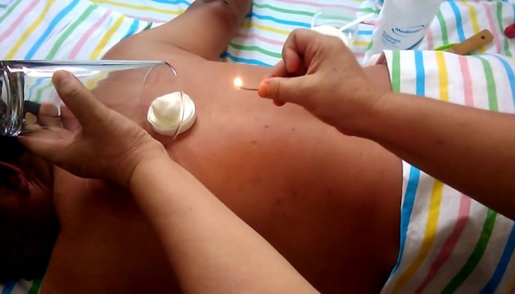 Las ventosas, una práctica milenaria, se usan para aliviar el dolor muscular. /Foto La Opinión n Remedios caseros olvidados