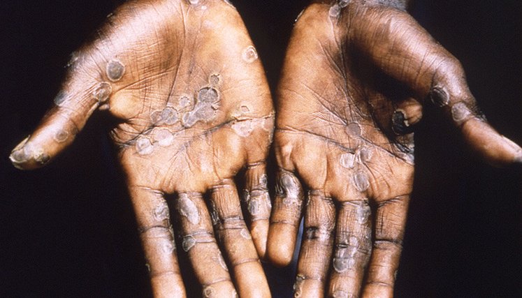 Virus-mpox.