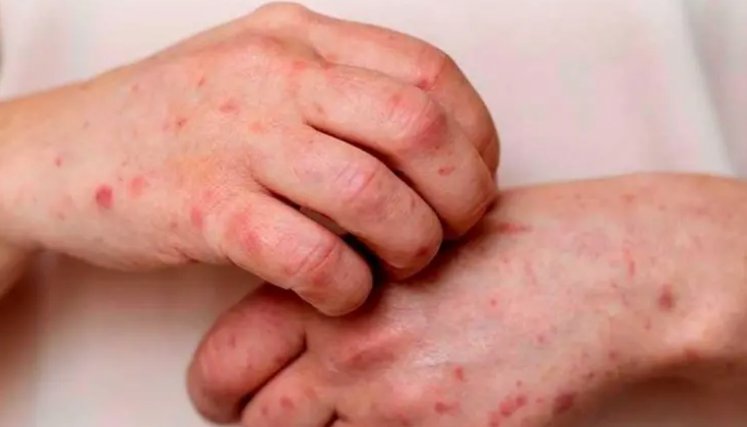 Se confirma segundo caso de mpox clado Ib en Colombia: se activó cerco epidemiológico de pasajero que llegó de Madrid a Bogotá