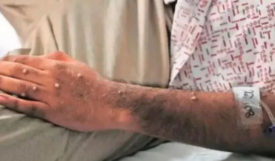 En Antioquia fue confirmado el primer caso de viruela símica del tipo más grave/Foto Colprensa