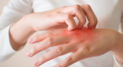 La dermatitis no es contagiosa, pero puede hacer que te sientas incómodo y cohibido. / Foto: Cortesía