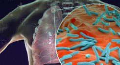 La tuberculosis es una de las principales causas de muerte en personas viviendo con VIH en el mundo.
