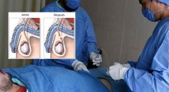Vasectomía