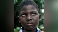 Albinismo ocular: una afección heredada en los ojos./Foto: tomadas de https://superatuenfermedad.com/