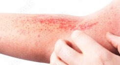 La dermatitis atópica, en su condición de enfermedad crónica, compromete la piel de las personas afectadas durante toda su vida. / Foto: Freepik