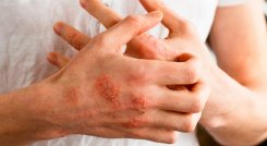La dermatitis afecta a cualquier persona