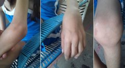 La artritis reumatoide es una enfermedad crónica que causa dolor en las articulaciones, rigidez, hinchazón y disminución del movimiento articular. / Foto: Cortesía