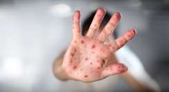 Viruela del mono en Norte de Santander. / Foto: Cortesía / La Opinión 