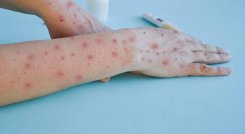 Ya hay 55 casos de viruela del mono en Colombia./Foto: internet
