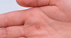 Virus del Papiloma Humano (VPH) 