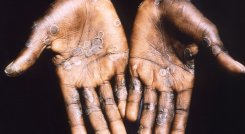 Virus-mpox.