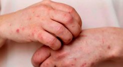 Se confirma segundo caso de mpox clado Ib en Colombia: se activó cerco epidemiológico de pasajero que llegó de Madrid a Bogotá