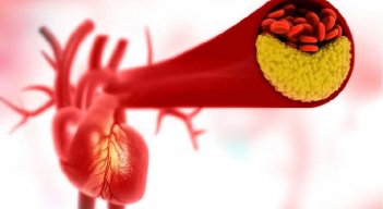 Arterosclerosis, enemigo de cuidado para tus arterias