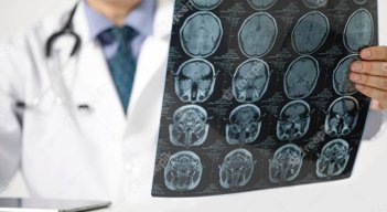 A medida que avanza la pandemia en el mundo, las investigaciones científicas encuentran nuevas marcas que deja la enfermedad, como lo son las afectaciones neurológicas. / Foto: Freepik