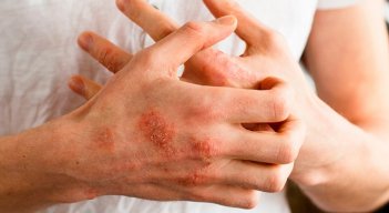 La dermatitis afecta a cualquier persona