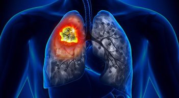 Fibrosis pulmonar