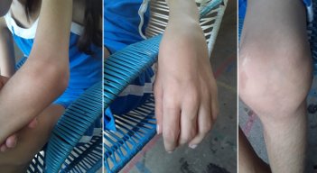 La artritis reumatoide es una enfermedad crónica que causa dolor en las articulaciones, rigidez, hinchazón y disminución del movimiento articular. / Foto: Cortesía