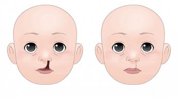 Cómo mejorar la calidad de vida de los niños con labio y paladar hendido