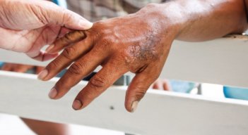 La lepra sí es curable. / Foto: Cortesía / La Opinión 