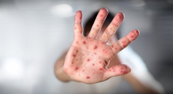 Viruela del mono en Norte de Santander. / Foto: Cortesía / La Opinión 