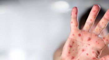 Descartan transmisión comunitaria de viruela del mono por casos confirmados