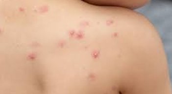 Viruela del mono ya está en Colombia