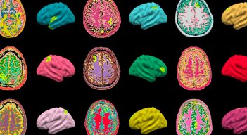 Inteligencia artificial podría ayudar a curar la epilepsia