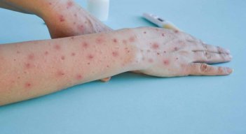 Ya hay 55 casos de viruela del mono en Colombia./Foto: internet