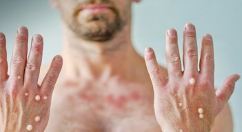 El primer paciente contagiado en la ciudad tiene 40 años y ya se recuperó.  / Foto: Cortesía / La Opinión 