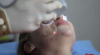 Acné. Foto: Internet